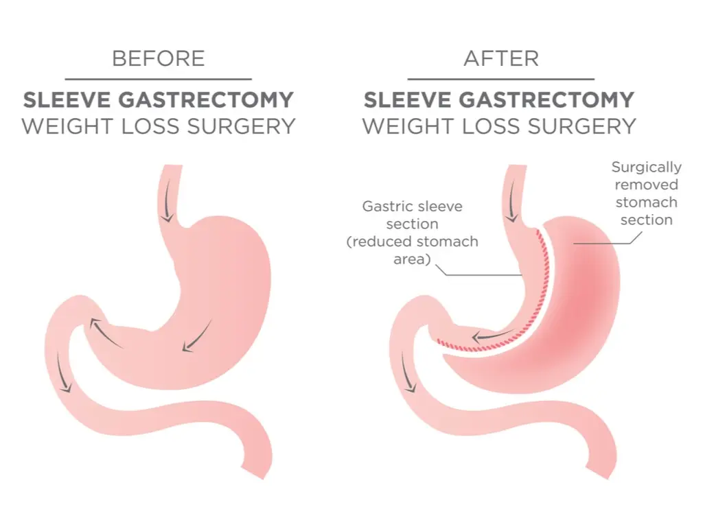 sleeve gastrectomy.